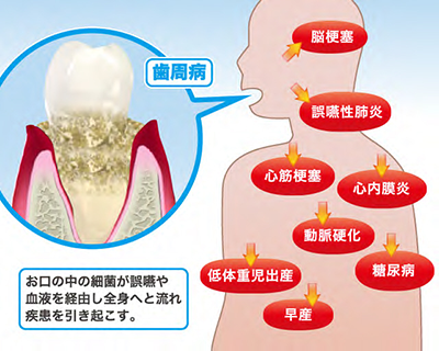 歯周病影響03