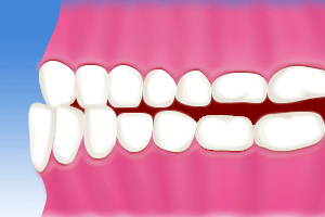 反対咬合